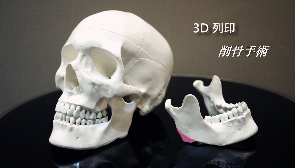 3D削骨手術,3D導航削骨,3D導版削骨,3D列印削骨
