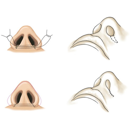 鼻头缩小手术|缩鼻头手术