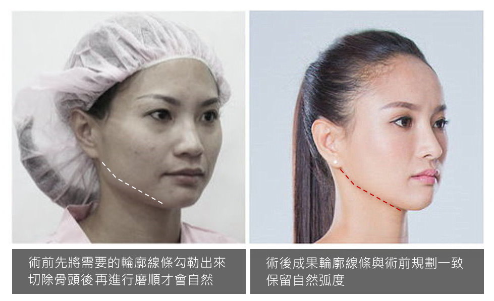 削骨,顴骨,下顎骨角,下巴V-Line截骨手術,削骨手術側面比對模擬線,郭菁松案例,削骨權威