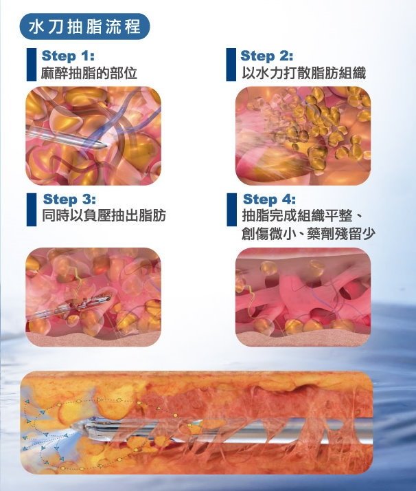 水刀抽脂流程圖