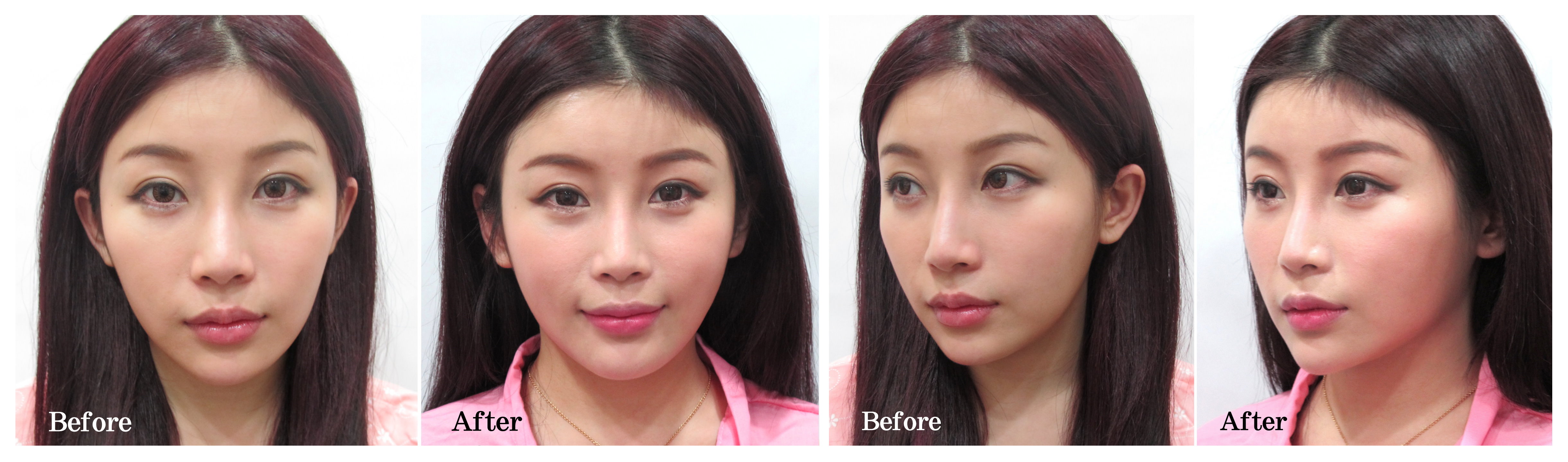 首页 案例分享 水刀抽脂案例 &nbsp; 以前的脸部比较骨感,经过补脂后