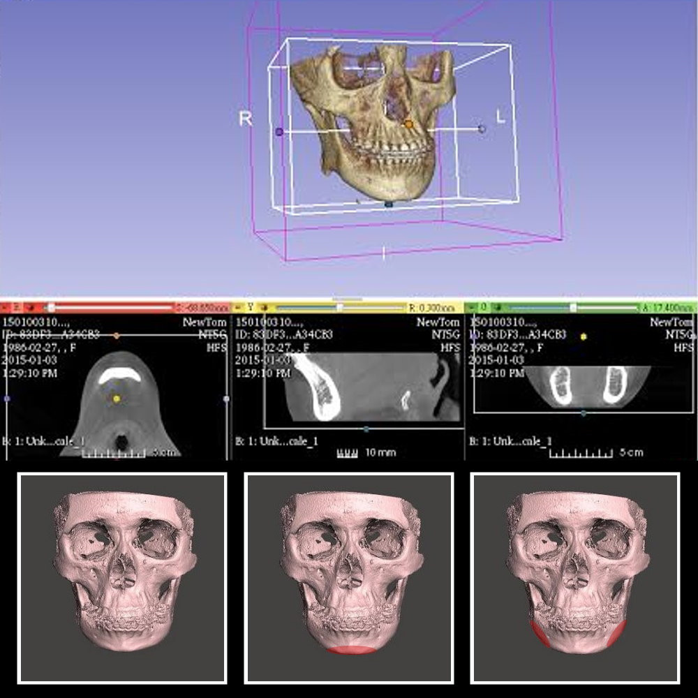 3D削骨權威,3D導航削骨推薦,3D列印導版削骨,3D列印削骨郭菁松