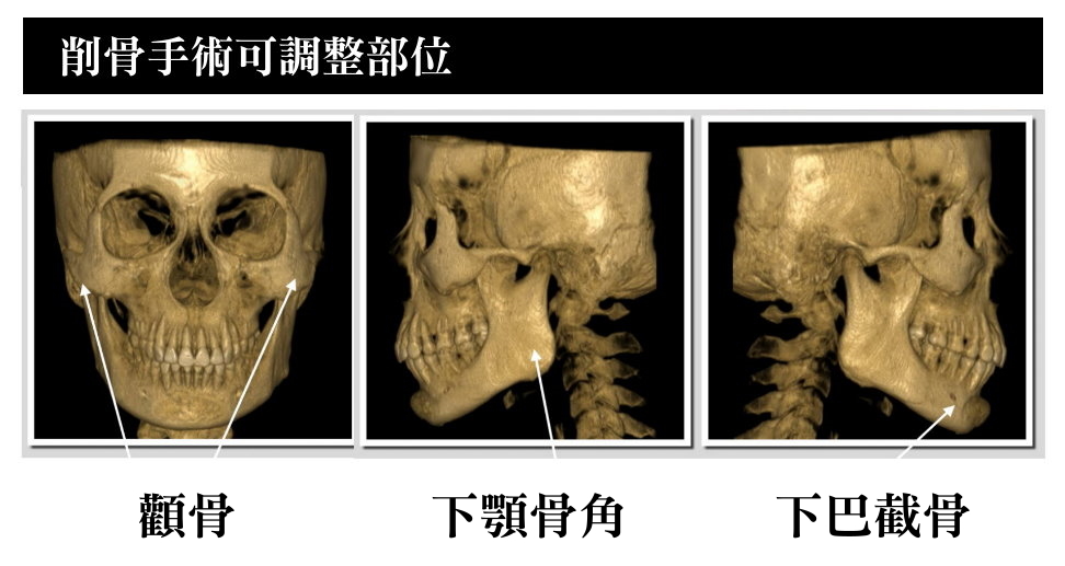 削骨術前3D拍攝,削骨X光,削骨顯影,削骨術前須知