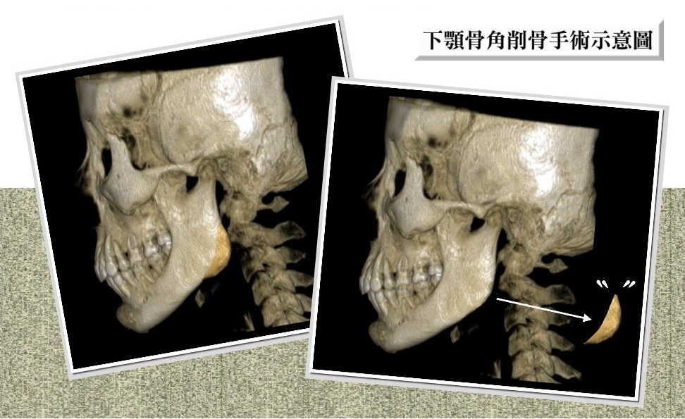 下顎骨角削骨改善狀況,下顎骨發達改善,下顎骨國字臉,削骨消除下顎骨