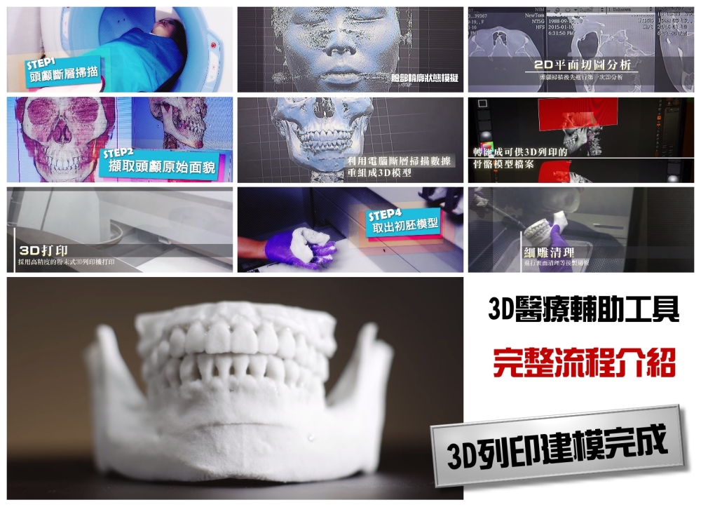  3D導航導版削骨流程, 3D削骨權威醫師, 3D削骨專家, 3D削骨權威推薦,郭菁松3D削骨