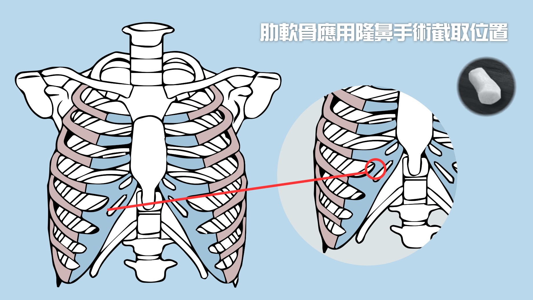 全自體肋軟骨隆鼻價格,全自體肋軟骨隆鼻費用,全自體肋軟骨隆鼻價錢,全自體肋軟骨隆鼻價位