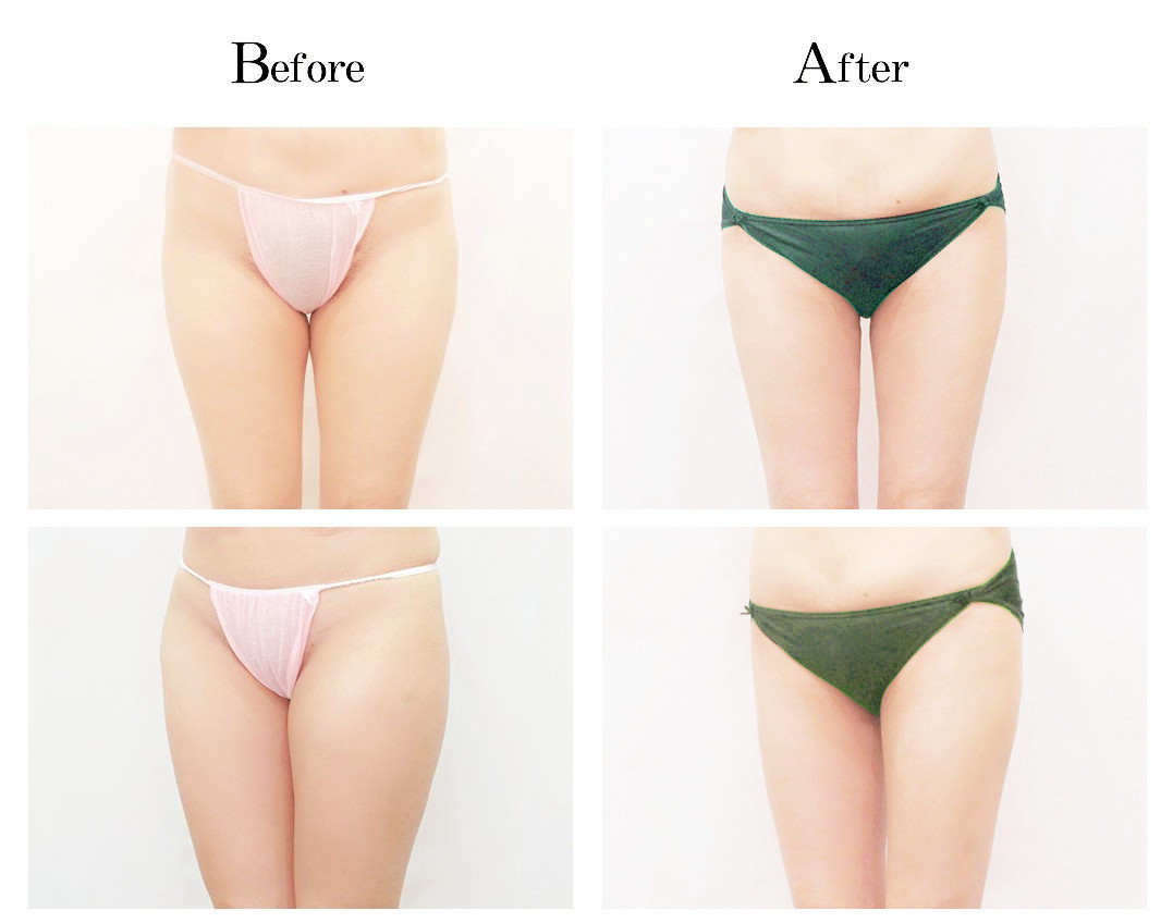 vaser liposuction before and after thigh and belly fat