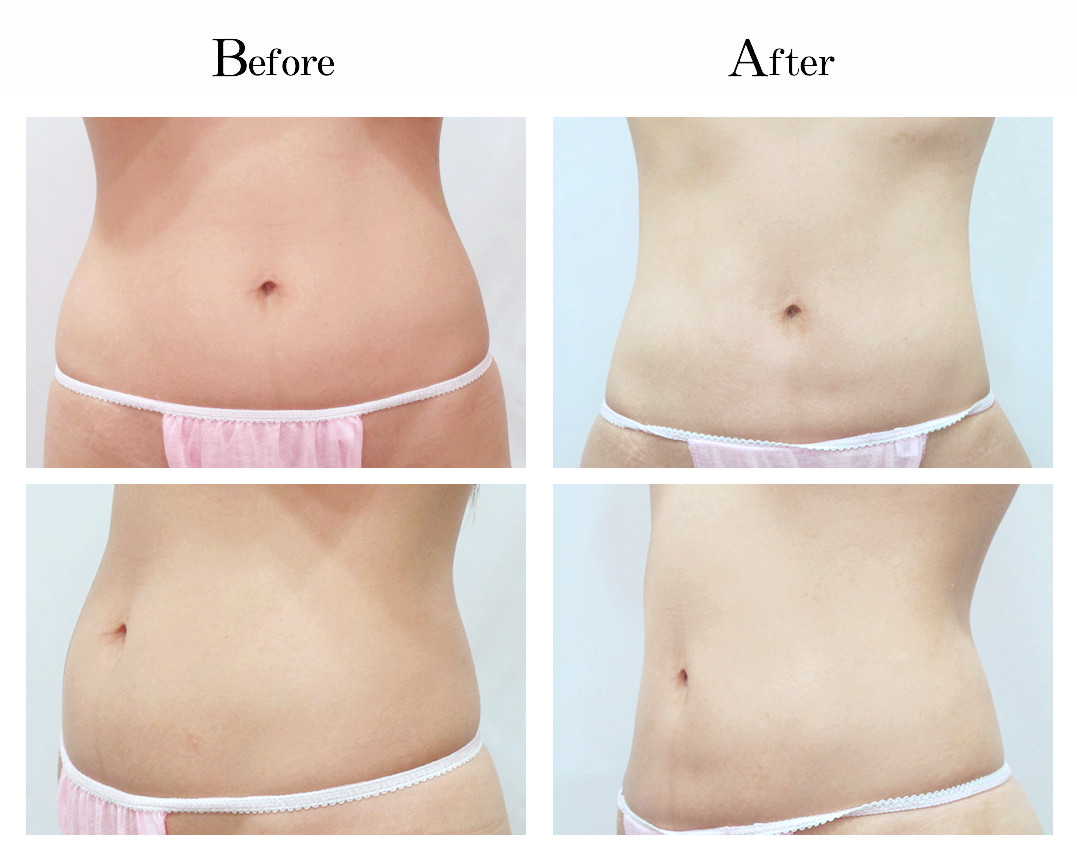 vaser lipo before and after stomach