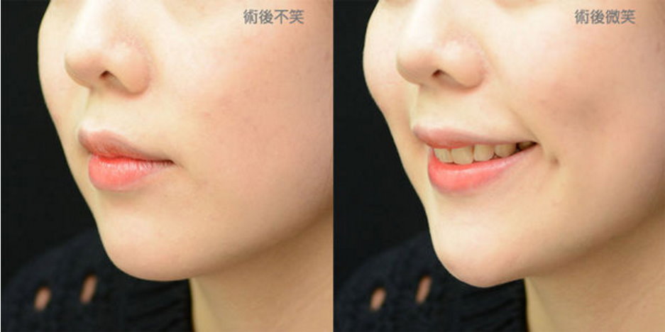 拉皮 台湾教主整形医美顶尖权威医师推荐