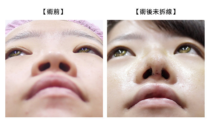 鼻整形傷口,隆鼻疤痕,隆鼻術後狀況