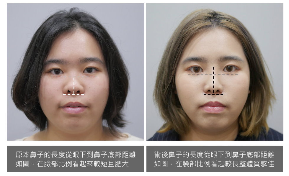 隆鼻手術前後照片比對,2022網美鼻整形隆鼻方式手術個案分析,擔心隆鼻失敗必看 - 隆鼻手術 台北.桃園.台中.台南.高雄 - 專業整形外科 ...