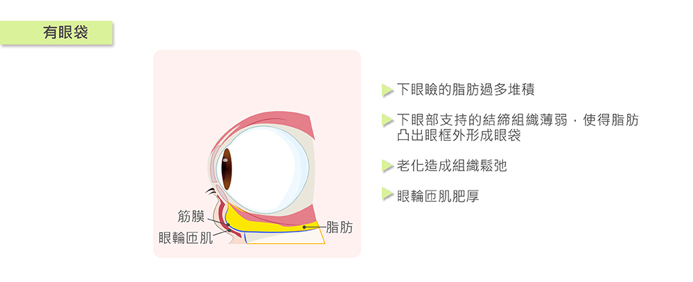 眼袋形成的原因,眼袋手術