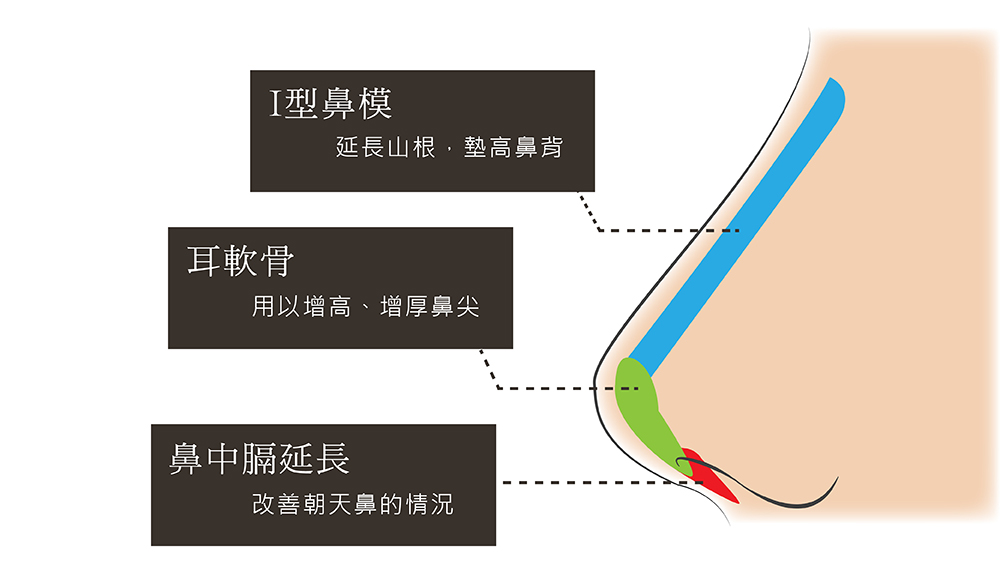 三段式隆鼻,耳軟骨,鼻中膈延長,隆鼻