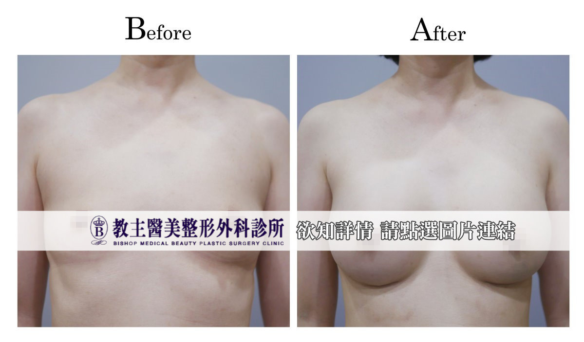 隆乳價錢,隆乳價格,隆乳價位,隆乳費用,隆乳權威,隆乳推薦