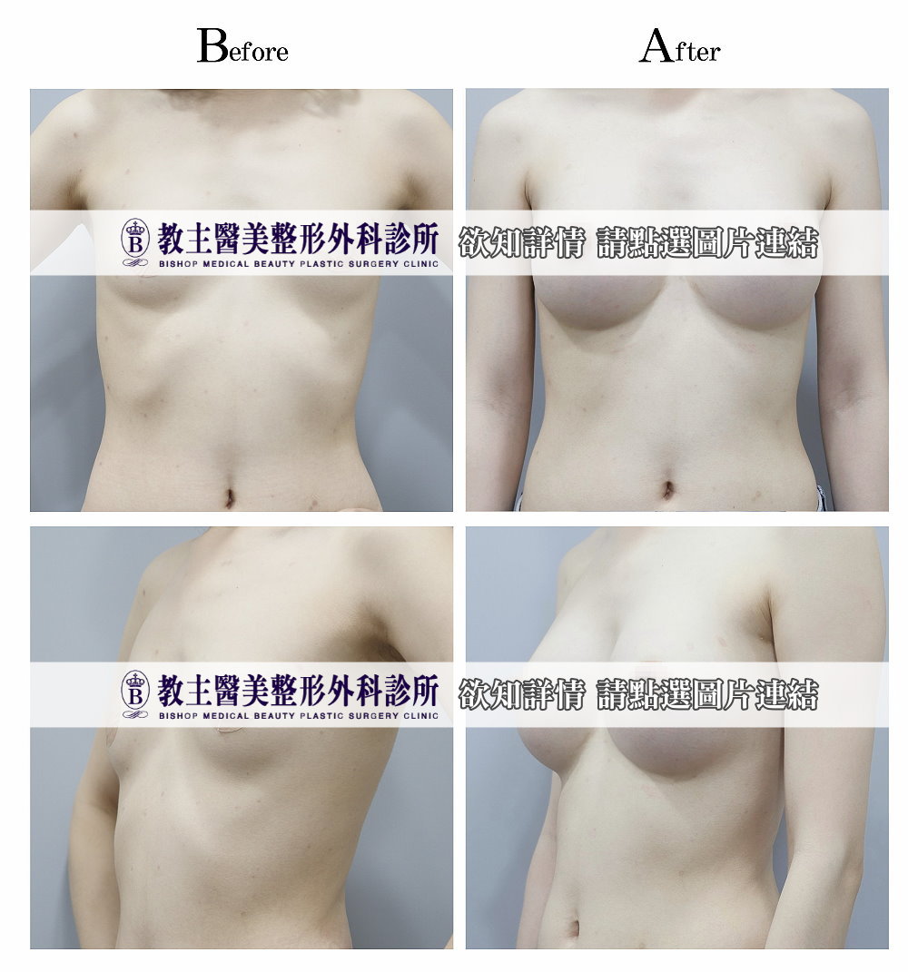 隆乳邱智弘,隆乳吳孟穎,隆乳林鴻祥,隆乳蔡青穎,隆乳權威推薦