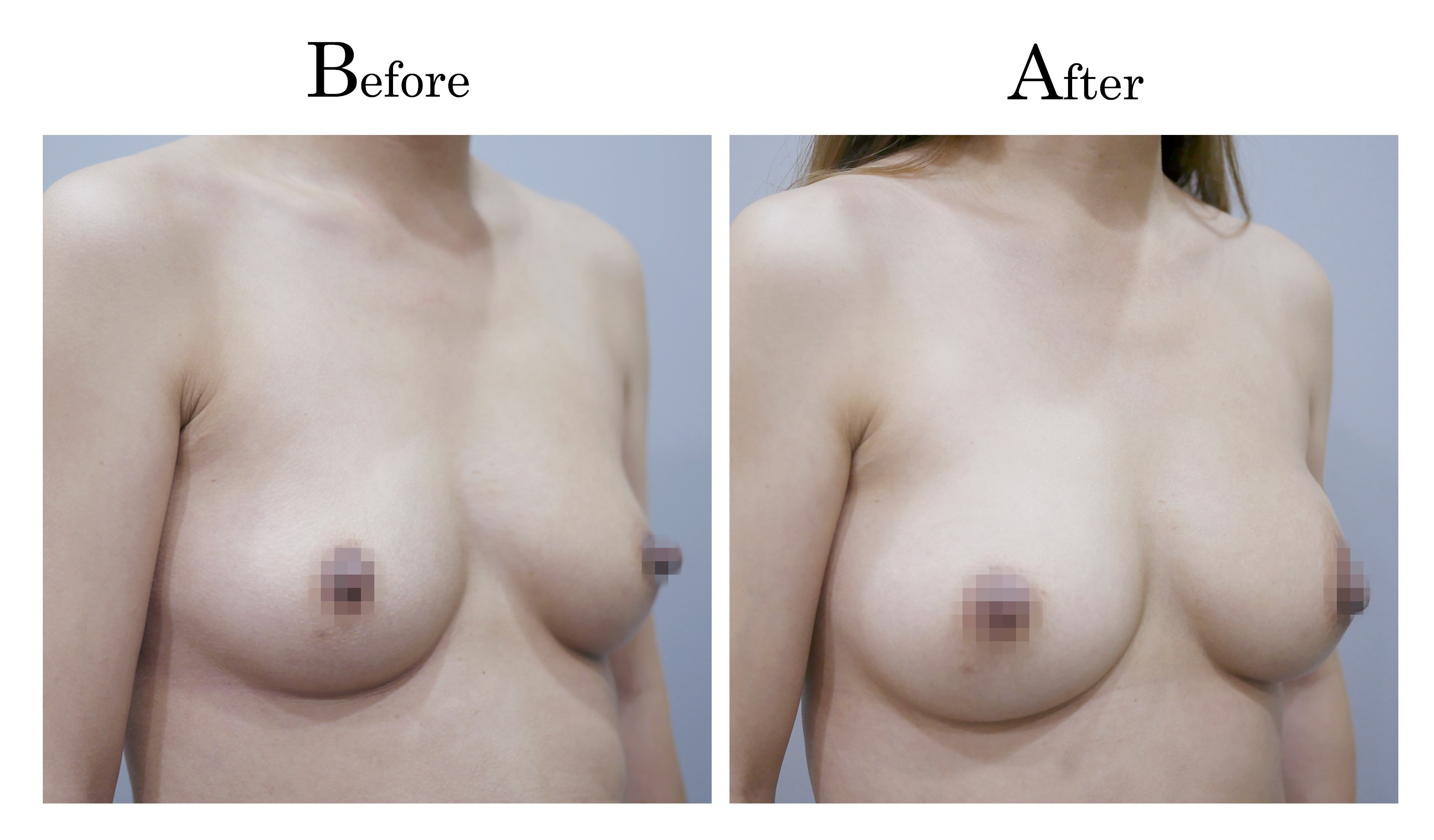 自體脂肪隆乳術前術後對比圖2