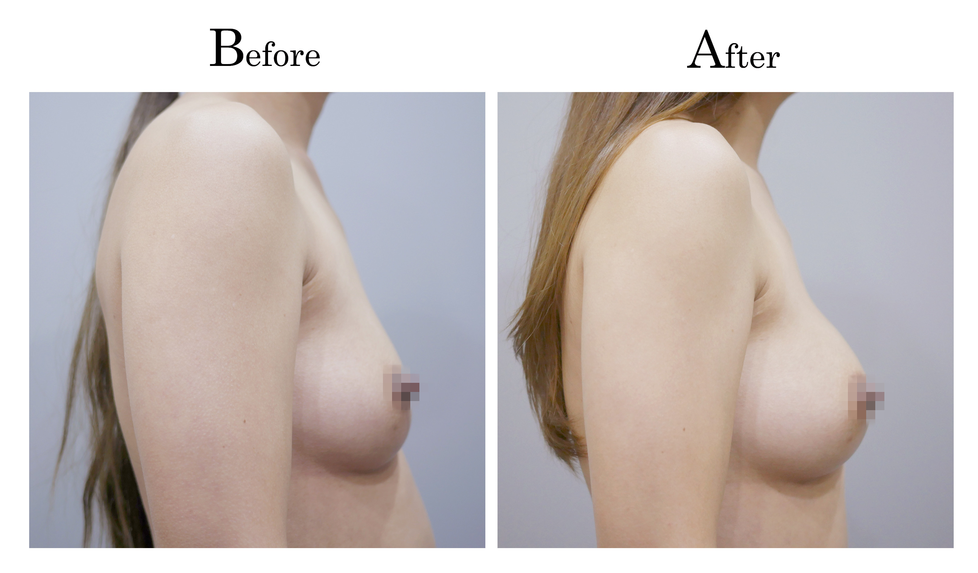 自體脂肪隆乳術前術後對比圖3