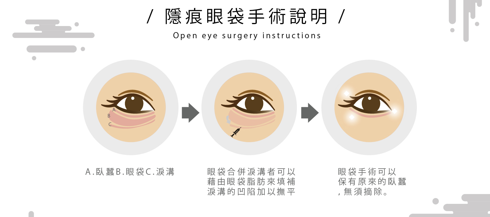 台北眼袋手術