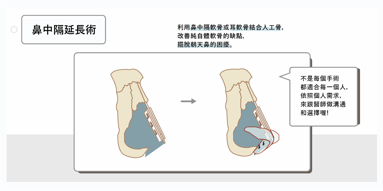 鼻中膈延長,鼻中膈彎曲手術