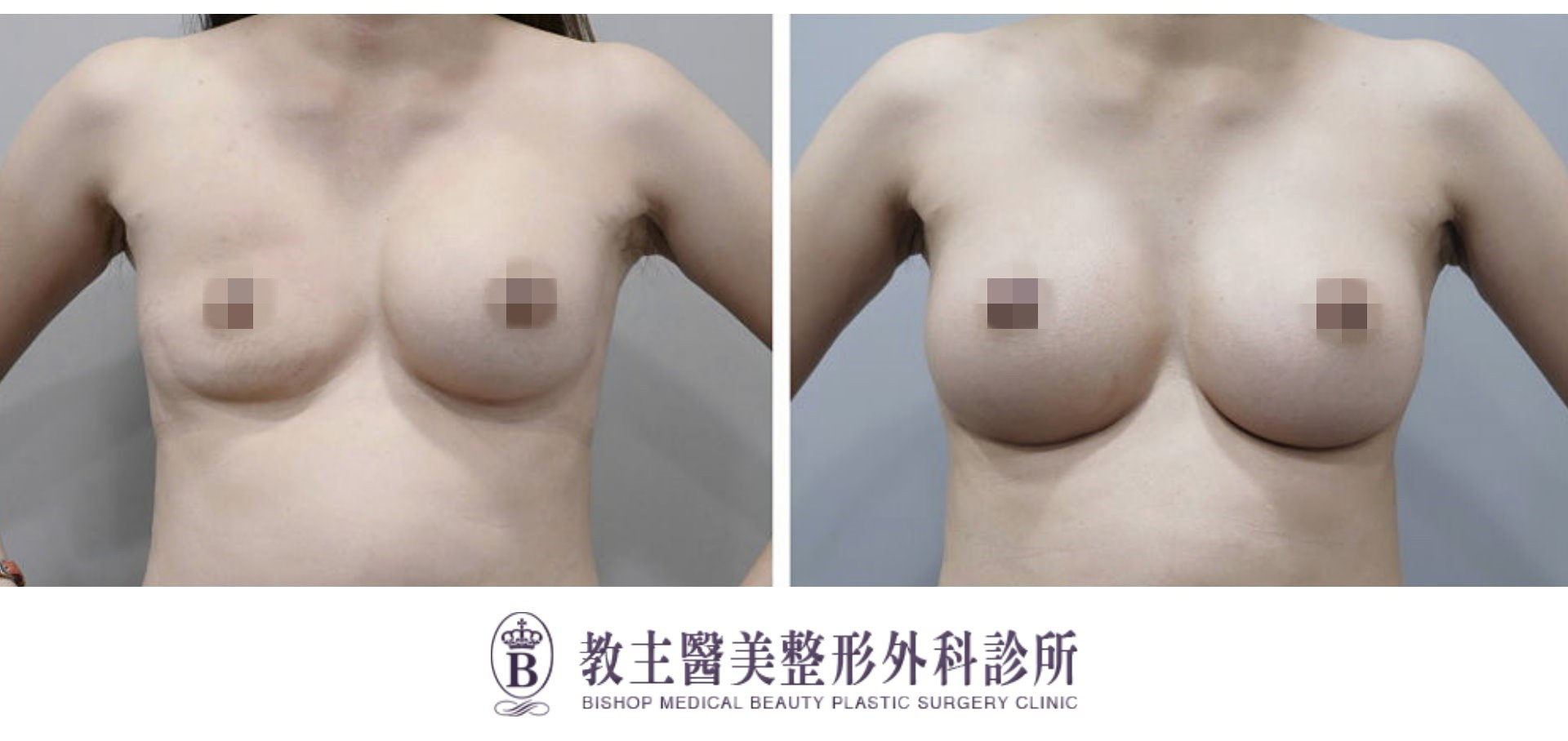 鹽水袋破裂隆乳失敗二次隆乳重建