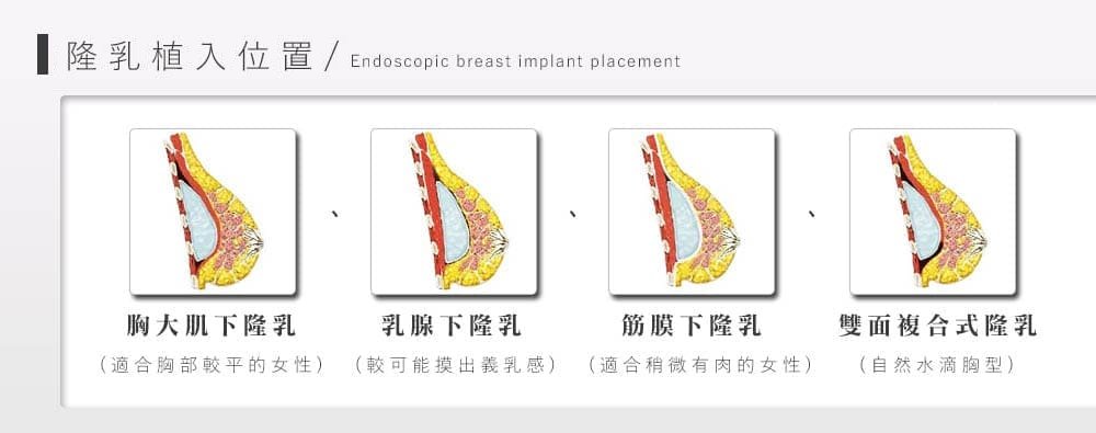 雙面複合式隆乳假體擺放位置