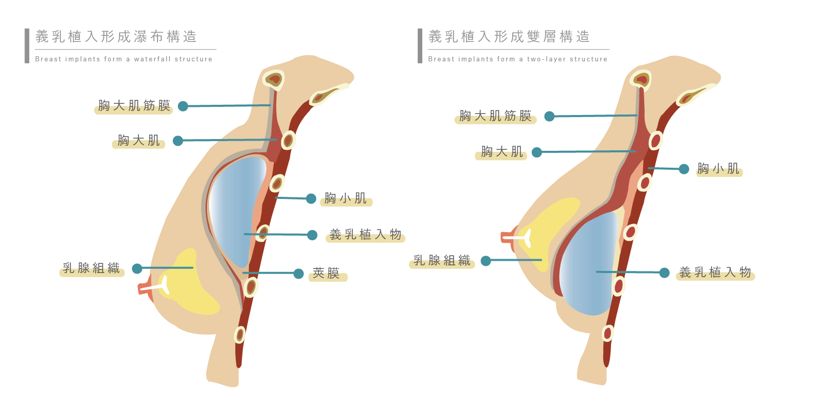 雙面複合式隆乳好在不會有一般隆乳失敗放置位置錯誤產生的問題