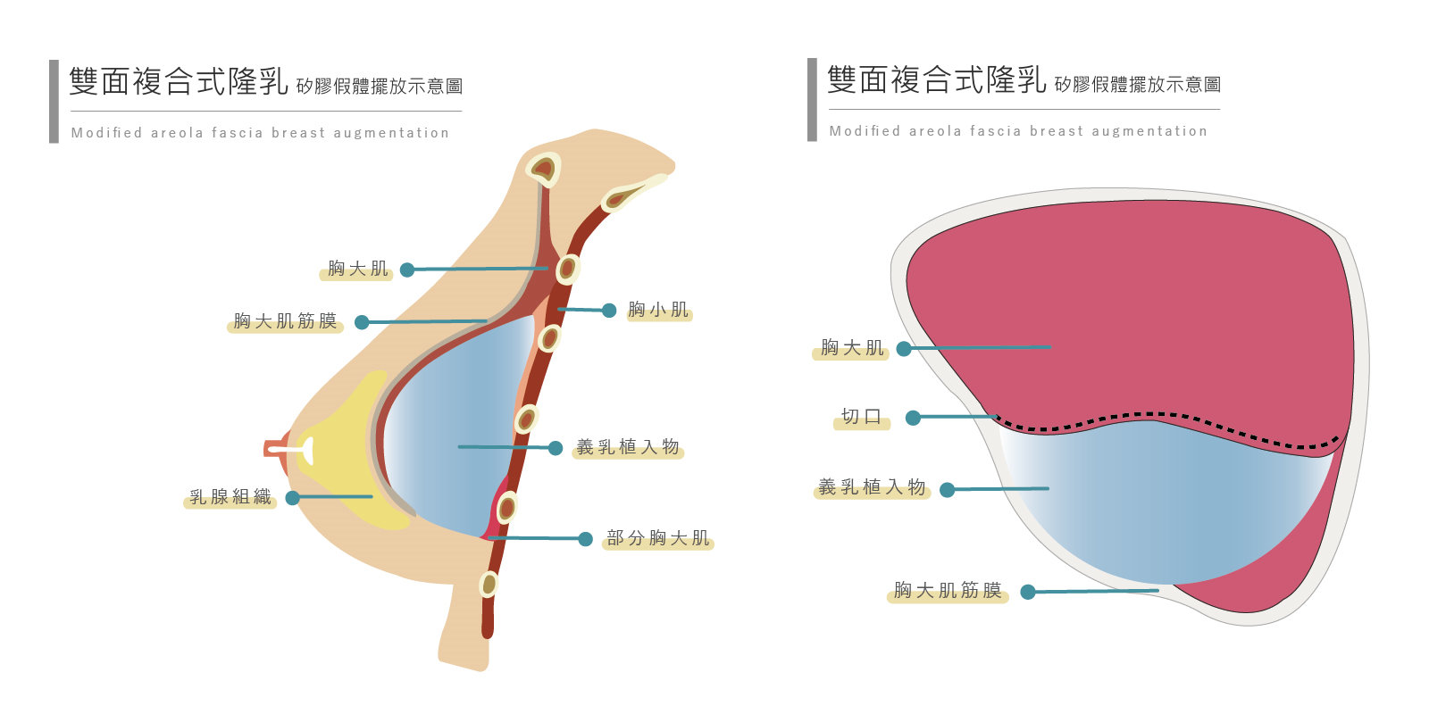 隆乳分享,隆乳日記