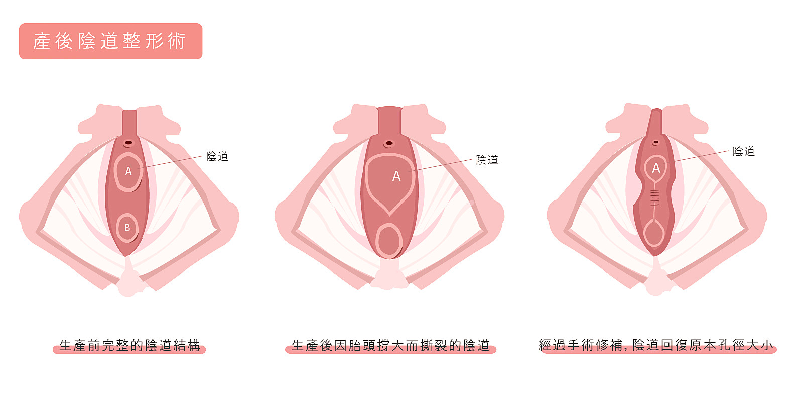 陰道緊實手術,產後陰道口縮緊