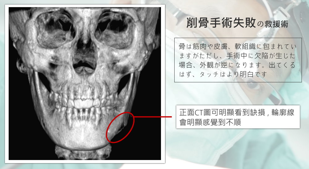 韓國削骨失敗