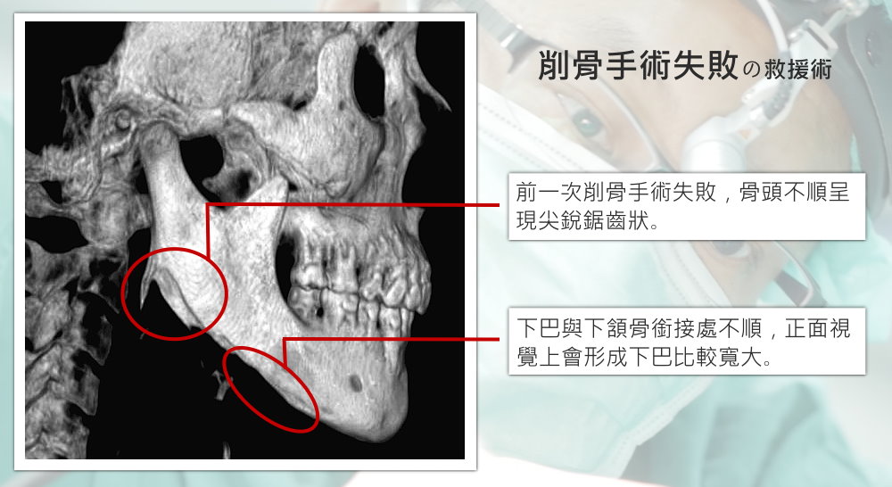 削骨失敗