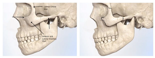顴骨內推內縮手術,退顴骨,顴骨內推內縮削骨,顴骨內推內縮骨折,改善顴骨寬