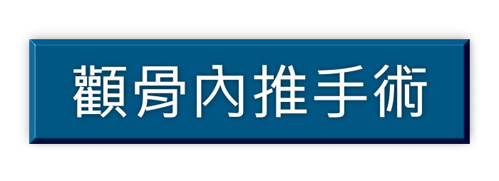 顴骨內推內縮退顴骨手術