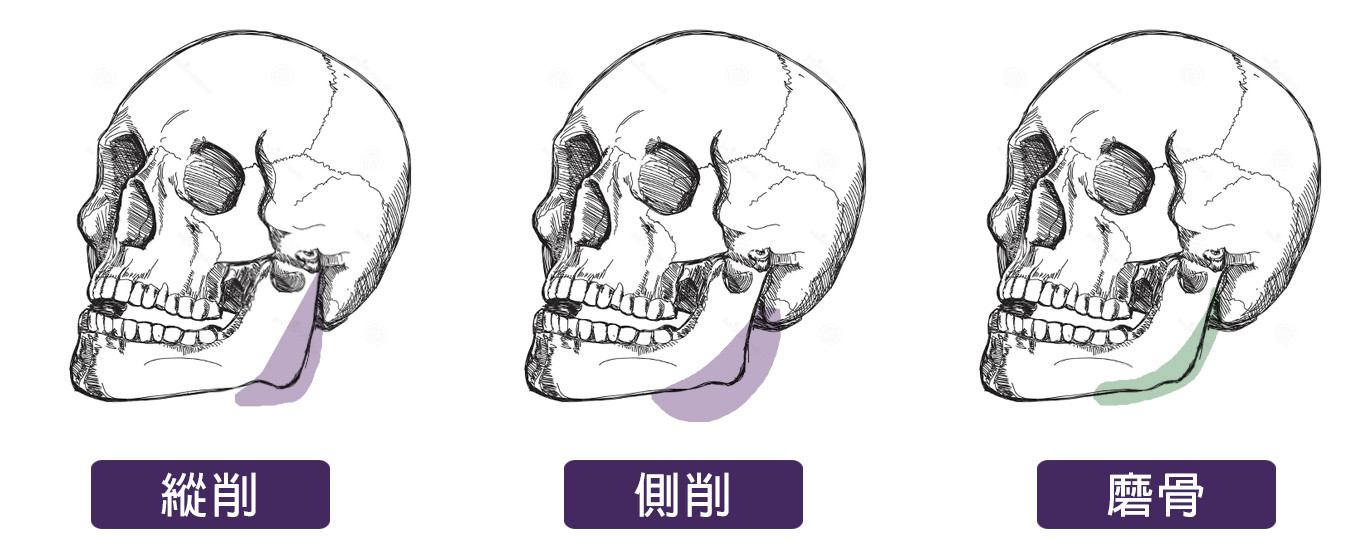 切下顎骨角,下顎骨角發達,國字臉下顎削骨