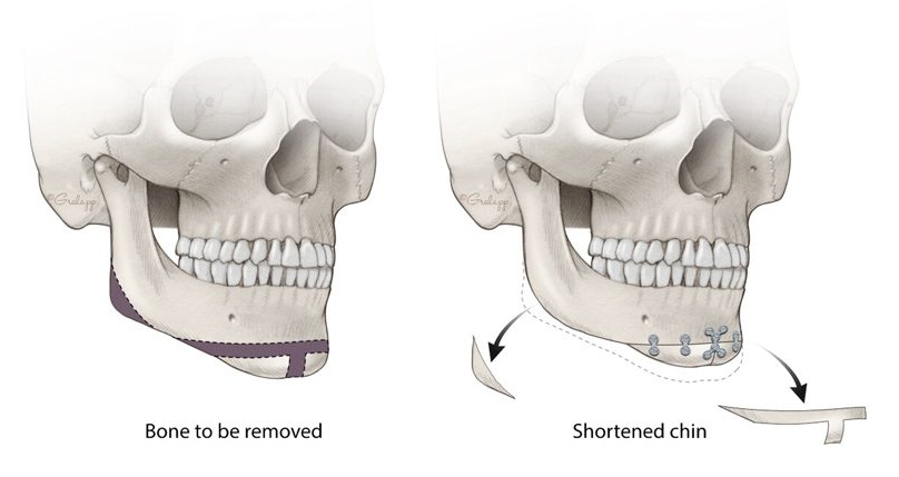 下巴削骨手術;V-Line截骨;削骨手術;下巴縮短手術