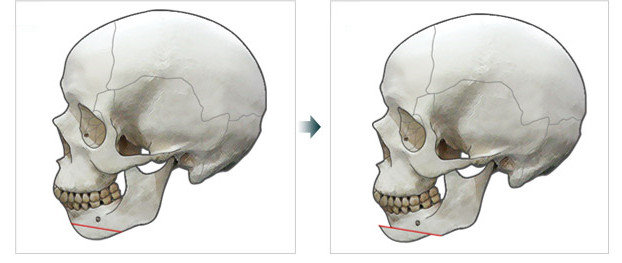 下巴後縮削骨,下巴截骨,下巴V-Line,下巴手術削骨,下巴削骨權威推薦,郭菁松