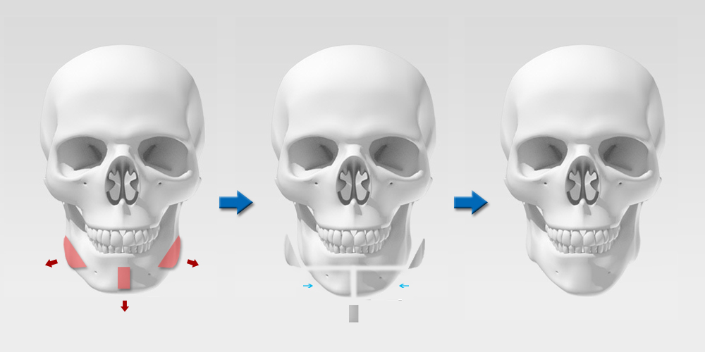 下巴削骨手術方式,下巴削骨截骨,下巴削骨改善寬度,下巴削骨改善長度
