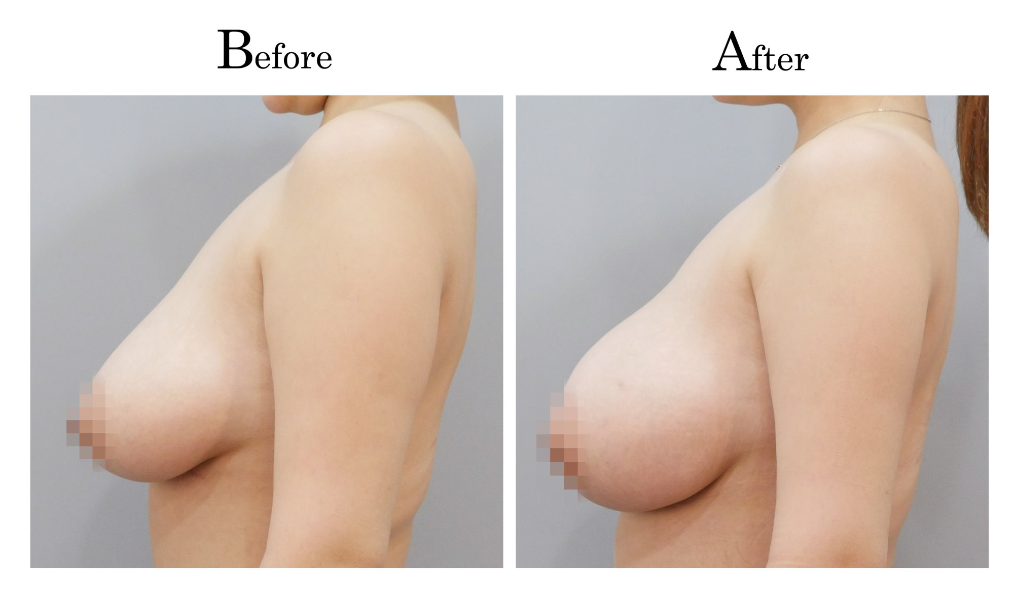 乳房下垂做自體脂肪隆乳