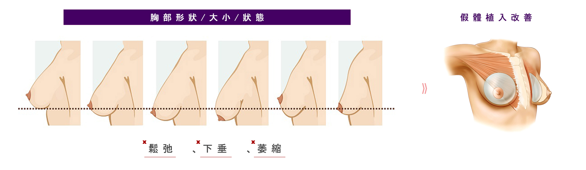 胸部形狀的大小除了與生俱來的自身條件以外