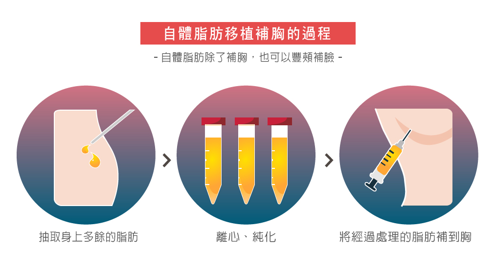 自體脂肪移植補胸過程