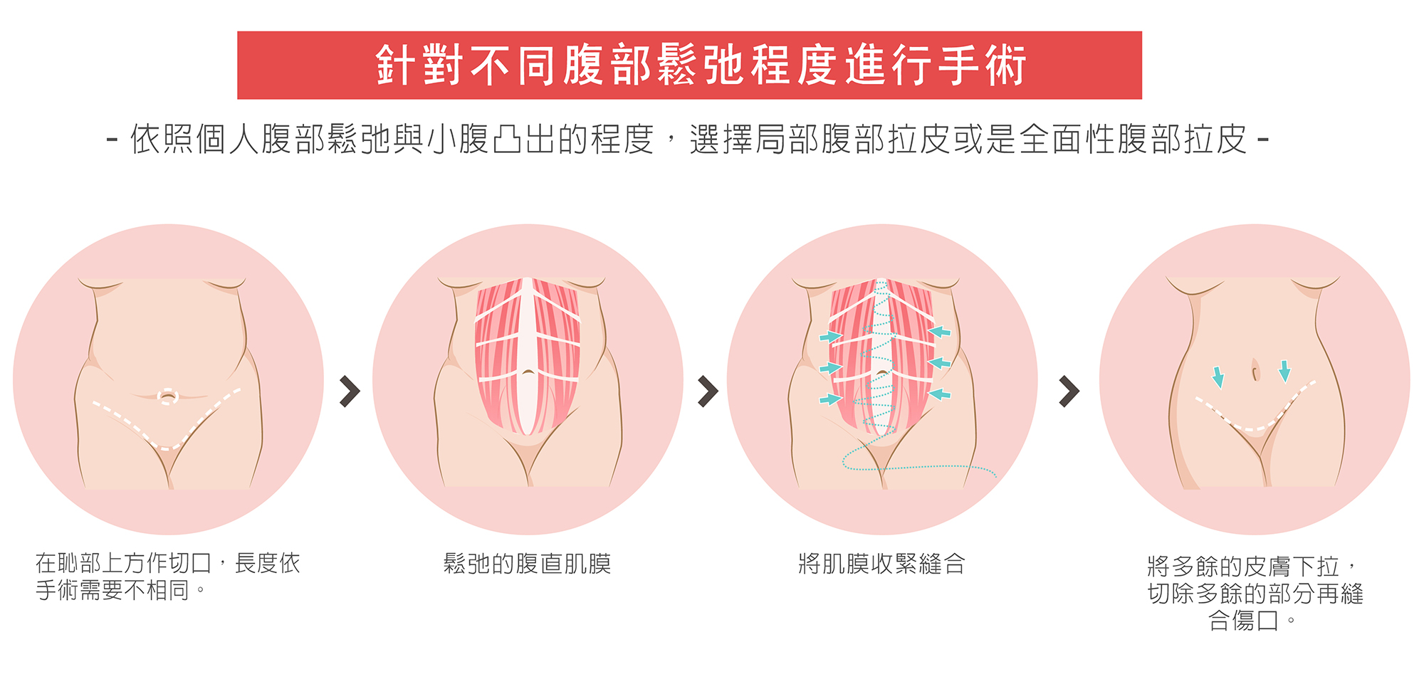 腹部拉皮手術介紹2