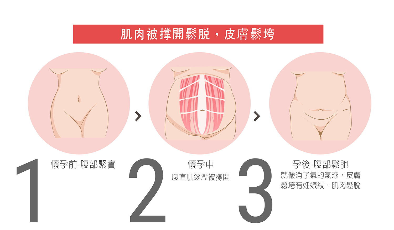 腹部拉皮手術介紹1