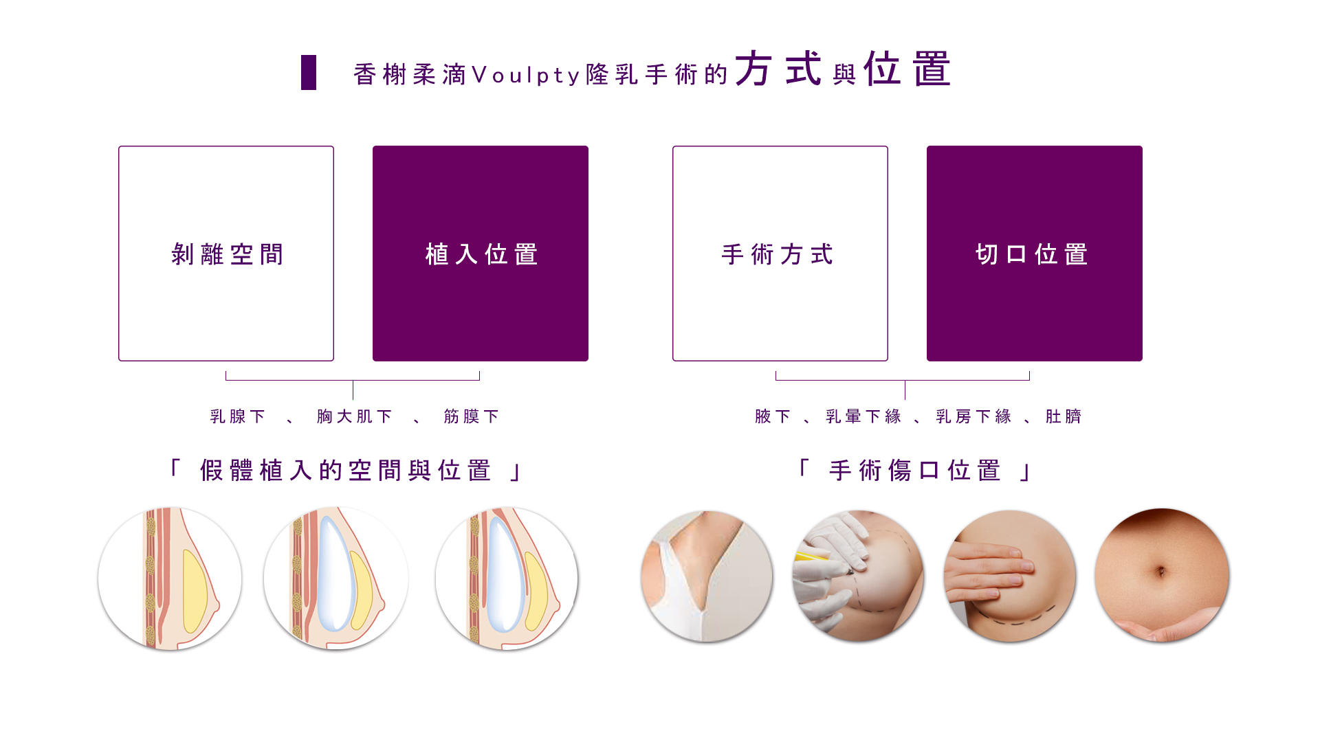 香榭柔滴Voulpty隆乳手術的方式與位置