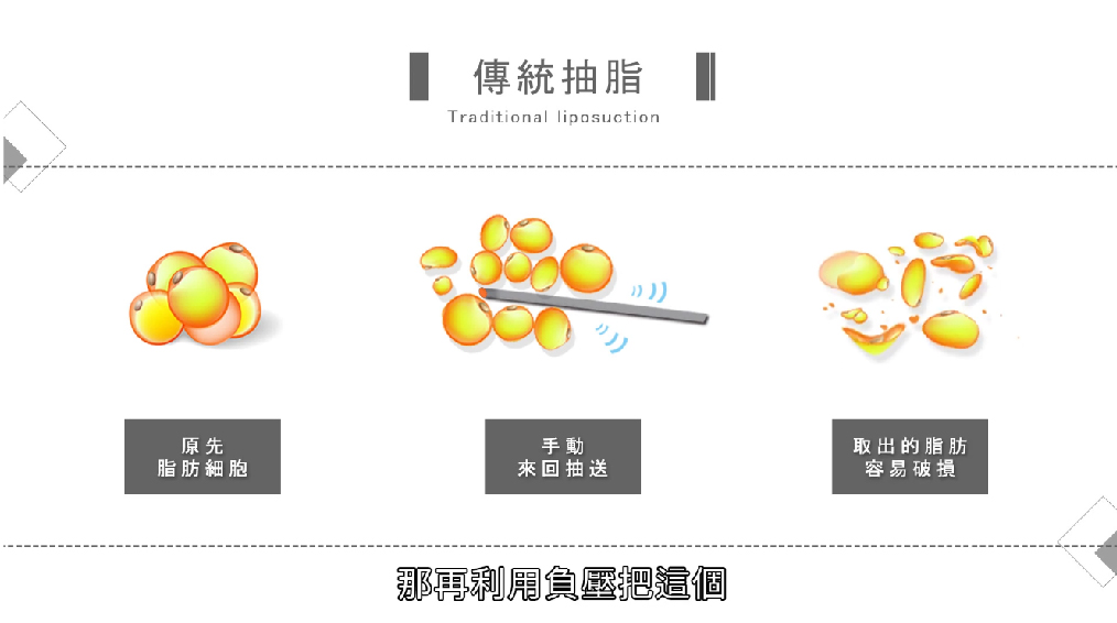 傳統抽脂示意圖